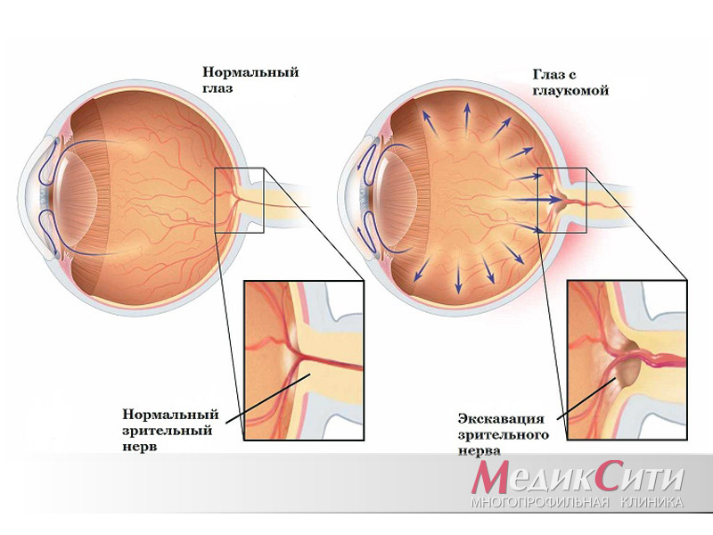 Внутриглазное давление (глаукома)