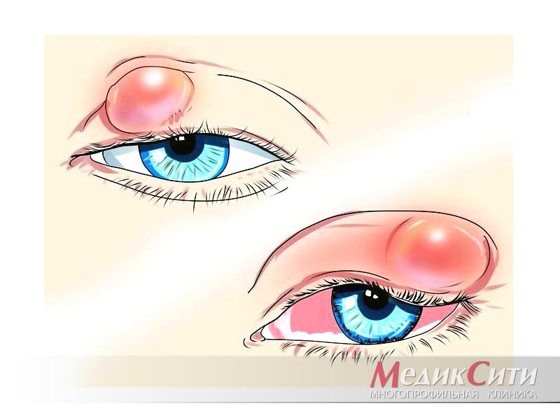 Острая боль в глазах: причины и способы лечения жжения в глазах